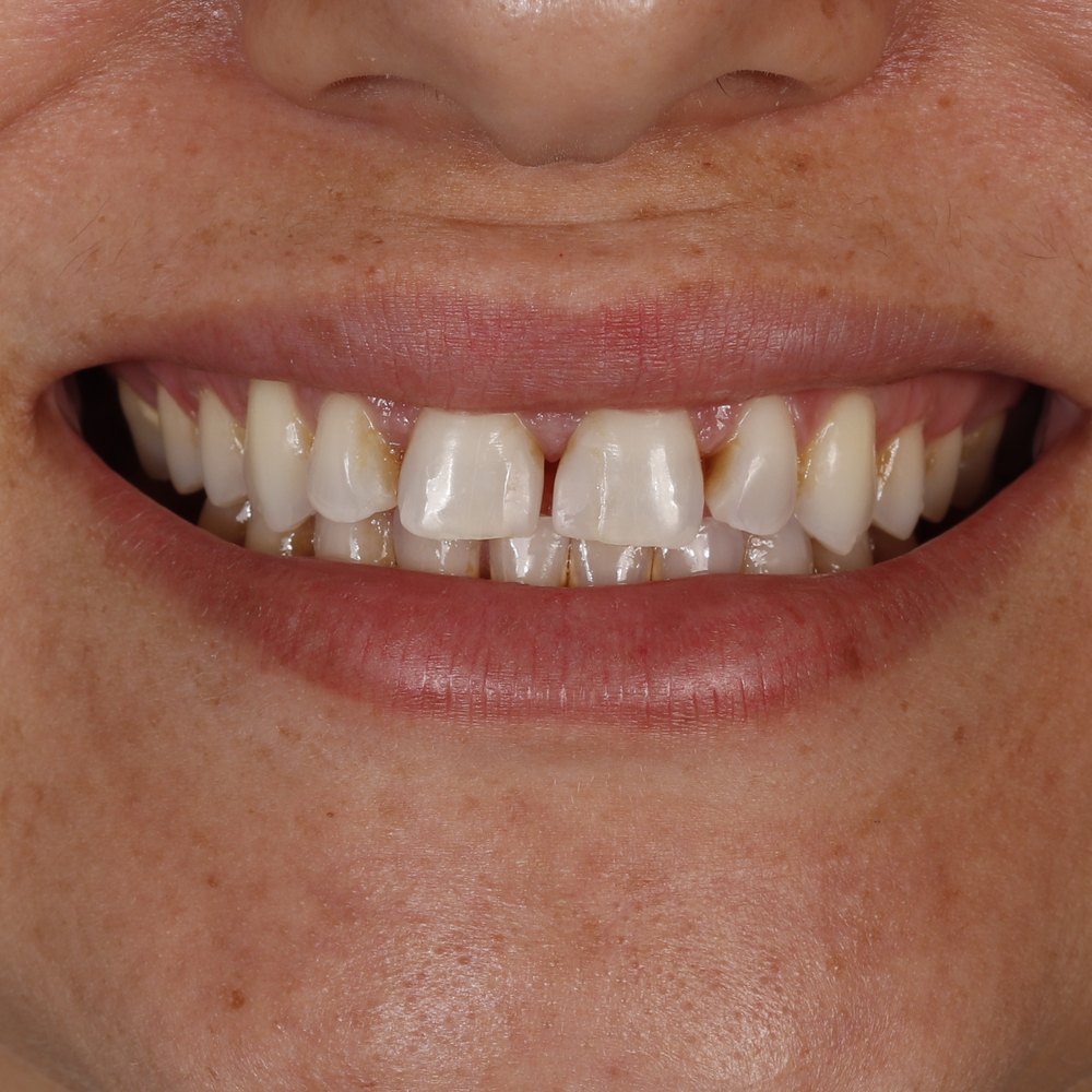 Sorriso da paciente Janaína antes do tratamento na Oral Unic Dourados