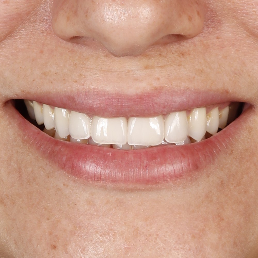 Sorriso da paciente Janaína depois do tratamento na Oral Unic Dourados