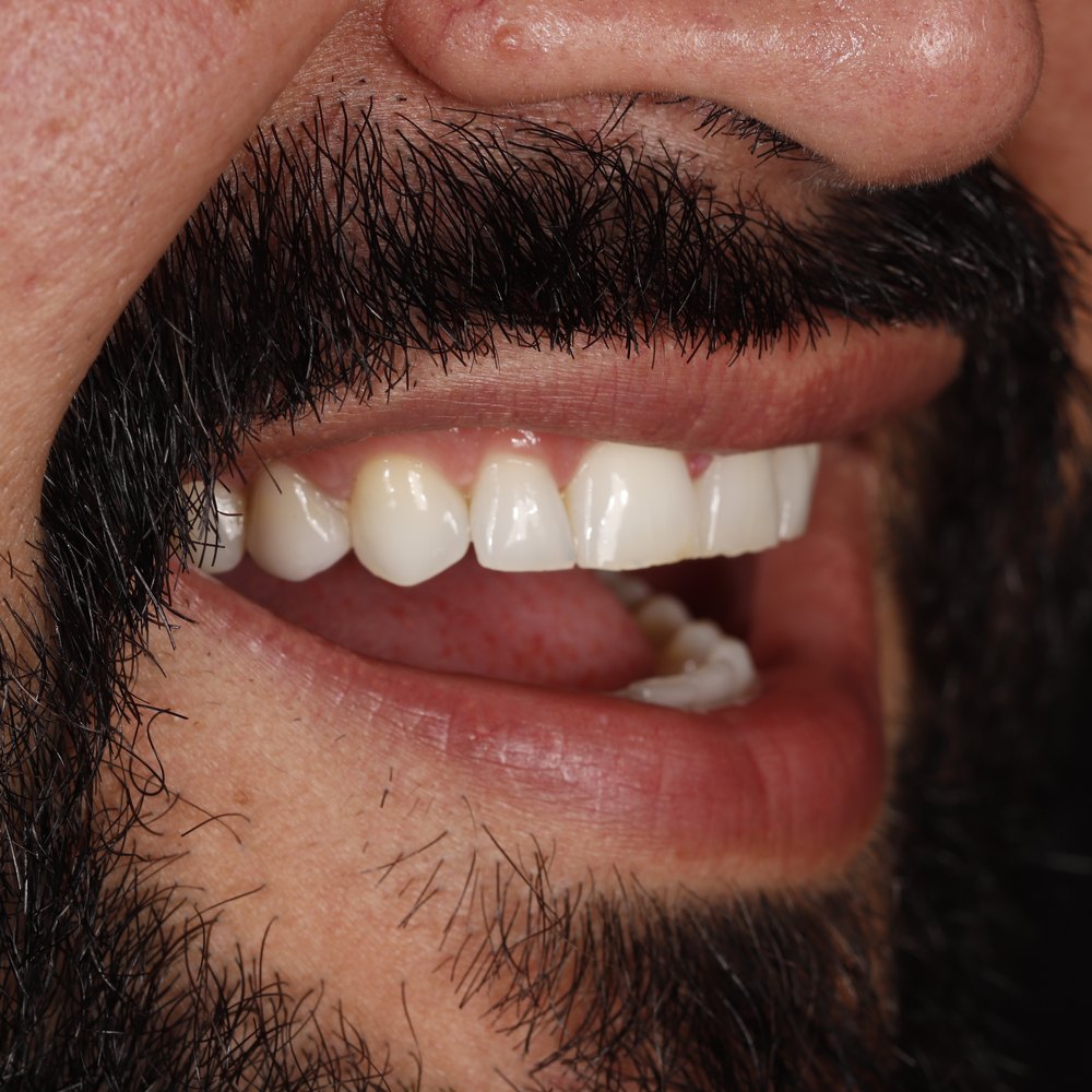 Sorriso do paciente Murilo antes do tratamento na Oral Unic Dourados