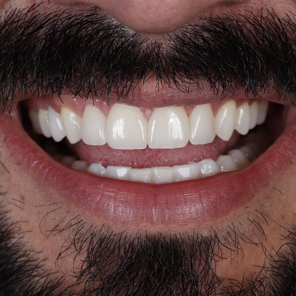 Sorriso do paciente Murilo depois do tratamento na Oral Unic Dourados