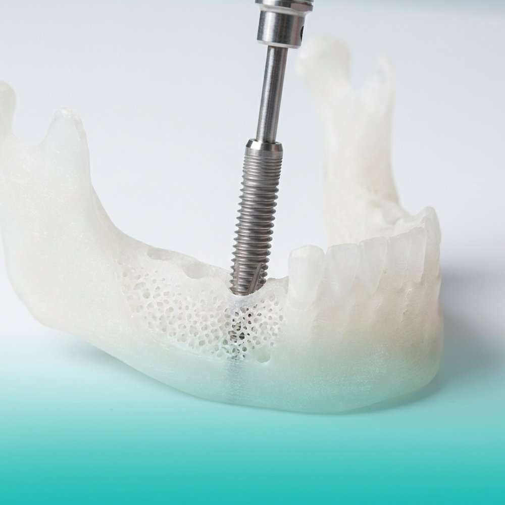 Implante dentário de titânio sendo posicionado em modelo 3D de mandíbula